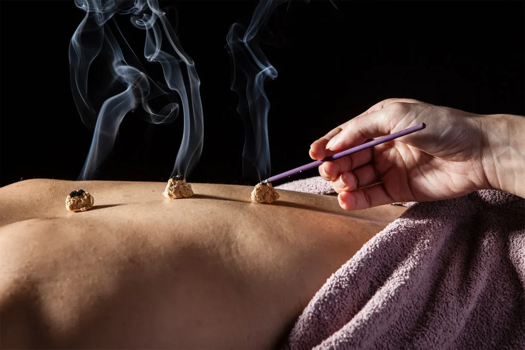 This image has an empty alt attribute; its file name is moxibustion-cones-moxa-treatment-points-top-needles-1024x682.webp